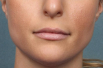 Juvederm Vollure Case 4 Before